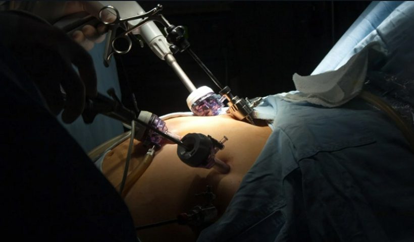 Gastric Sleeve Surgery