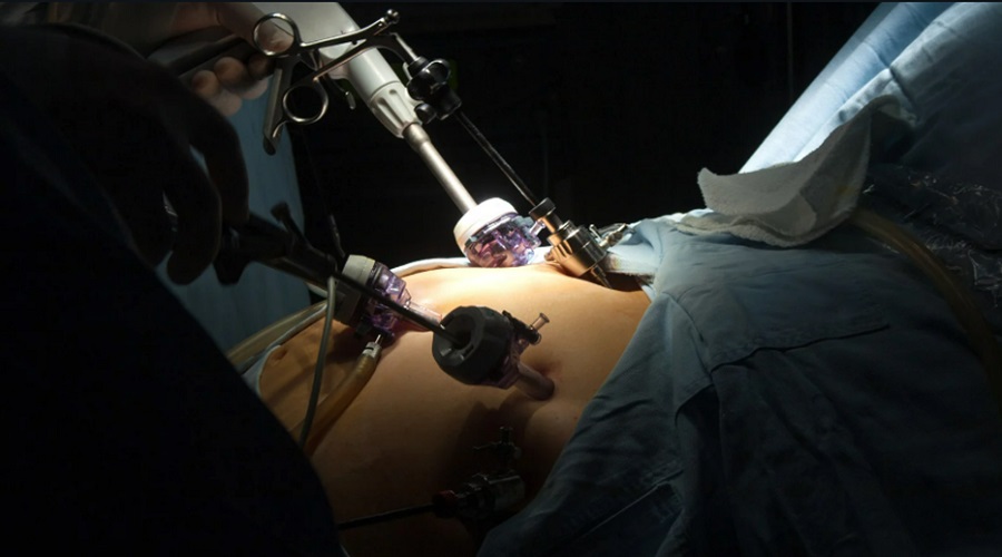 Gastric Sleeve Surgery